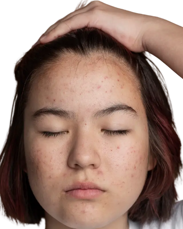 5 Signs Your Makeup Is Worsening Your Acne (And How to Fix It)