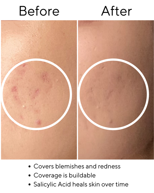 Powder Foundation with Salicylic Acid